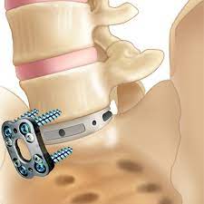 Lumbar Anterior Spinal Fusion Surgery