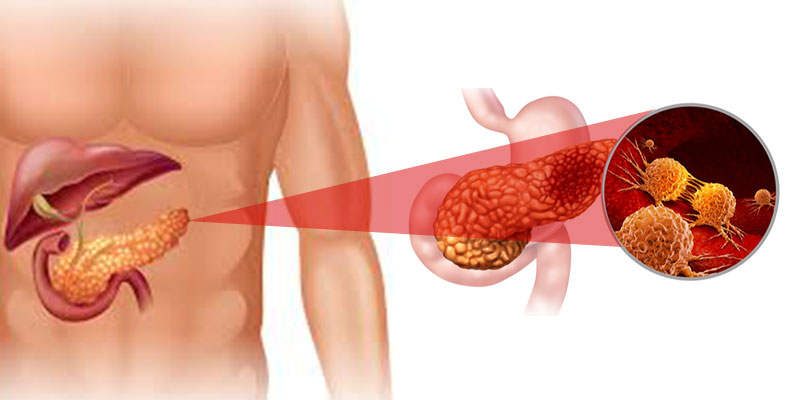 Pancreatic Cancer treatment