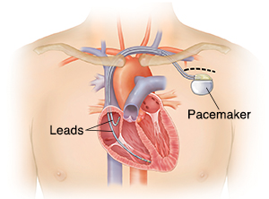 Permanent Pacemaker Implantation