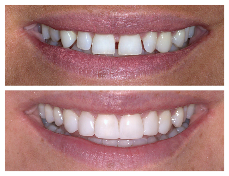 Smile Design Procedure Composite Bonding Space Closure