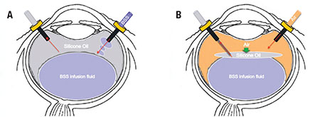 VITREO RETINAL PROCEDURES Silicon Oil Removal Single Eye