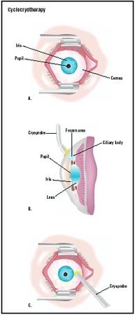 GLAUCOMA PROCEDURES Cyclocryotherapy Single Eye