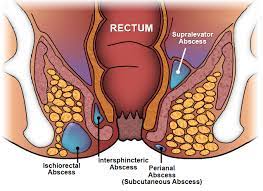 Perianal Abscess