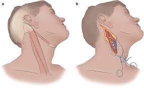 Decompression Spine Anterior Approach Cervical