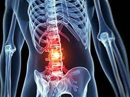 Tlif 1 Level With Decompression and Tlif II Level With Decompression