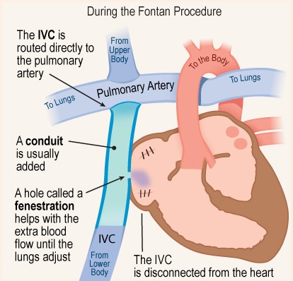 Fontan Procedure