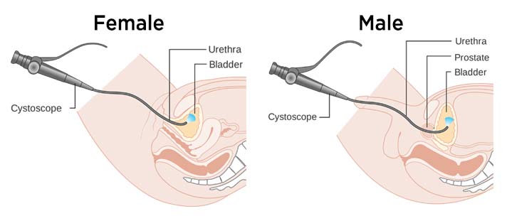 Cystoscopy