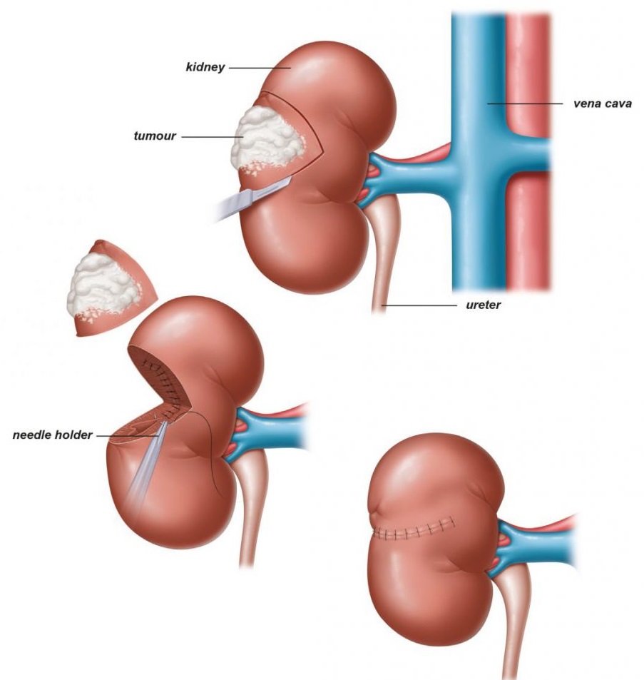 Partial Open Nephrectomy