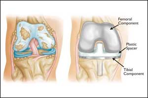 Arthroscopic Meniscectomy Partial or Subtotal Arthro
