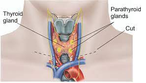Thyroidectomy Total