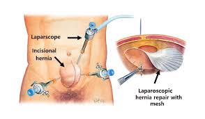 Incisional Hernia Repair With Or Without Mesh