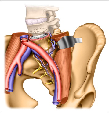 Decompression Spine Anterior Approach Dorsal