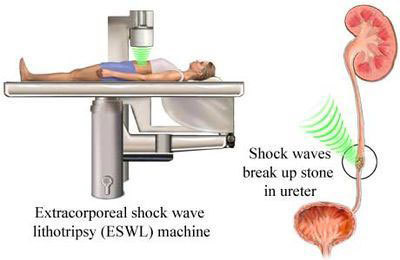 Lithotripsy Eswl