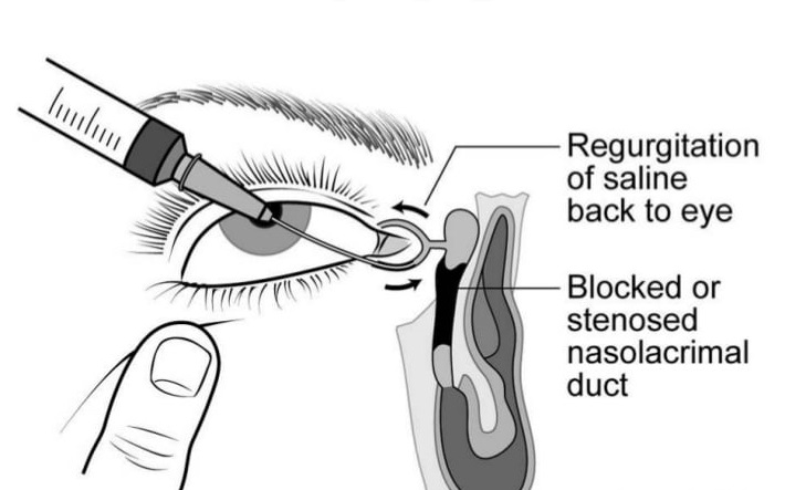 ORBIT AND OCULOPLASTY Syringing and Probing Single Eye