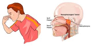 Angioﬁbroma Excision
