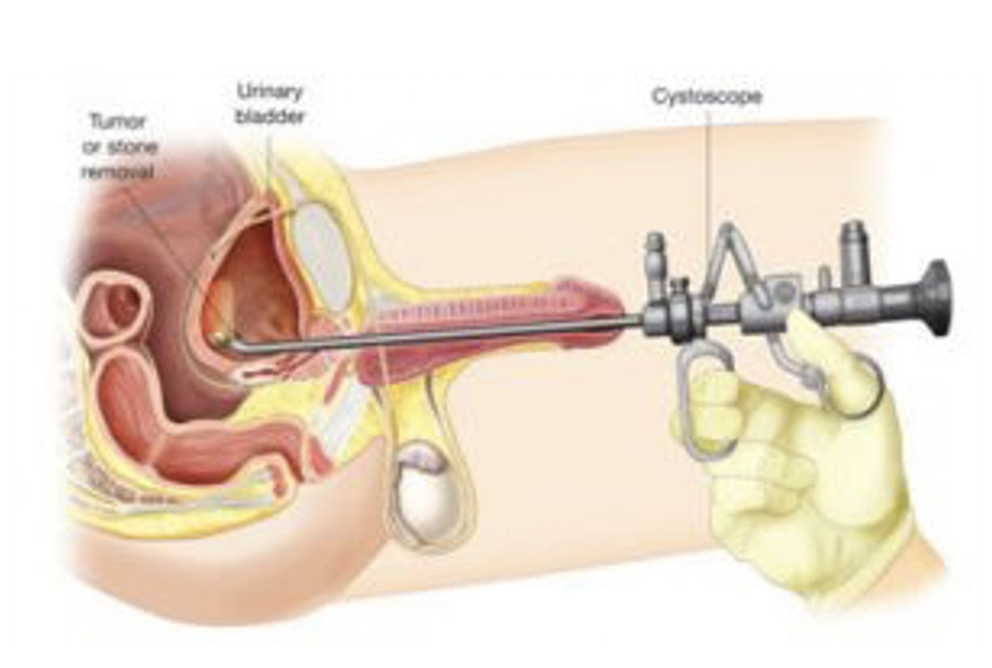 Cystoscopy & TURBT
