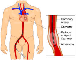 Angioplasty Surgery