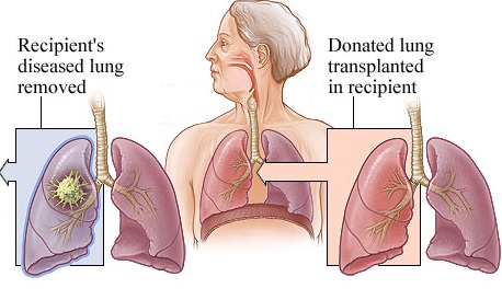 Lung Transplant