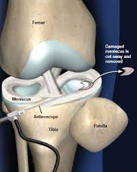 Arthroscopic Meniscectomy