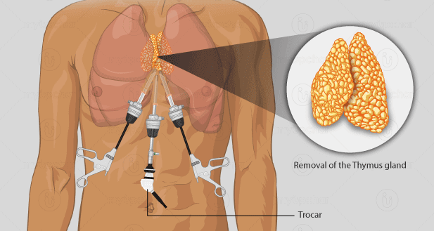 Thymectomy