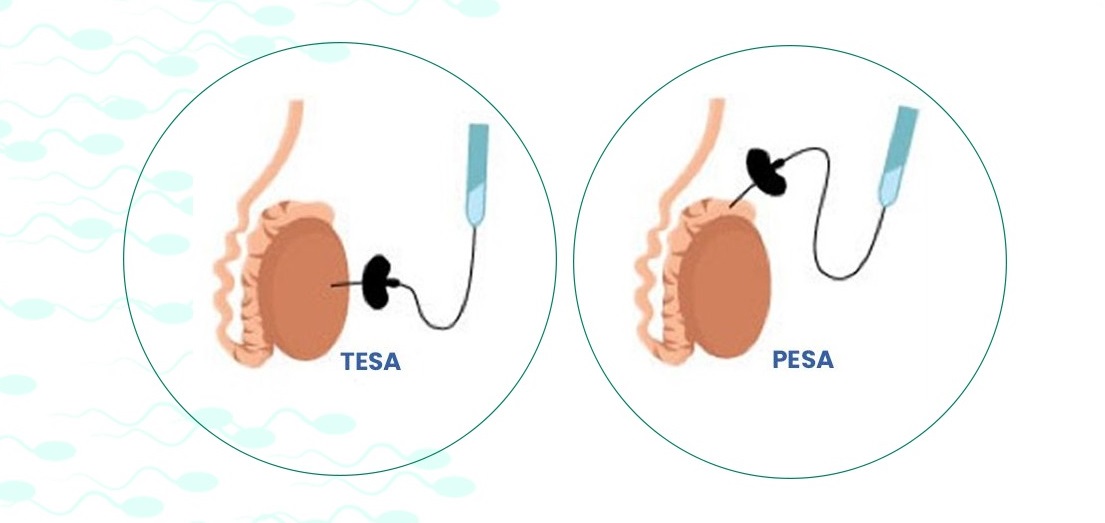 TESA or PESA