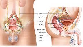 Cystectomy Radical and Ileal Conduit