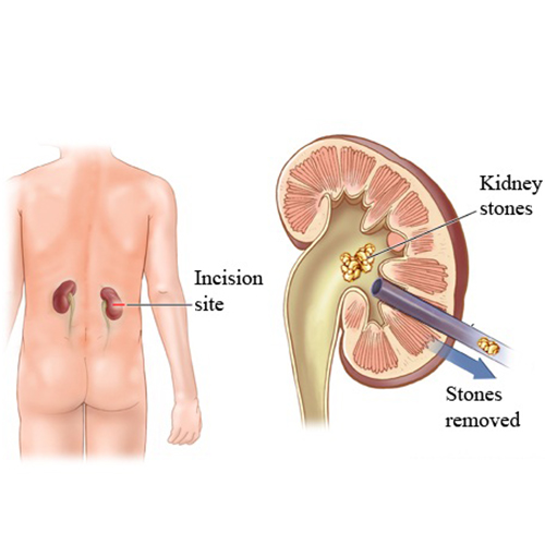 PCNL Greater Than 2 Cm