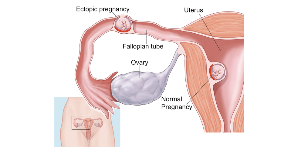 Ectopic Laparotomy Emergency