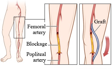 Femoro Popliteal Bypass
