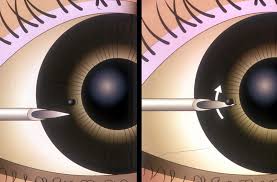 Foreign Body Removal Superficial