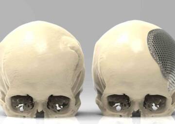 Cranioplasty