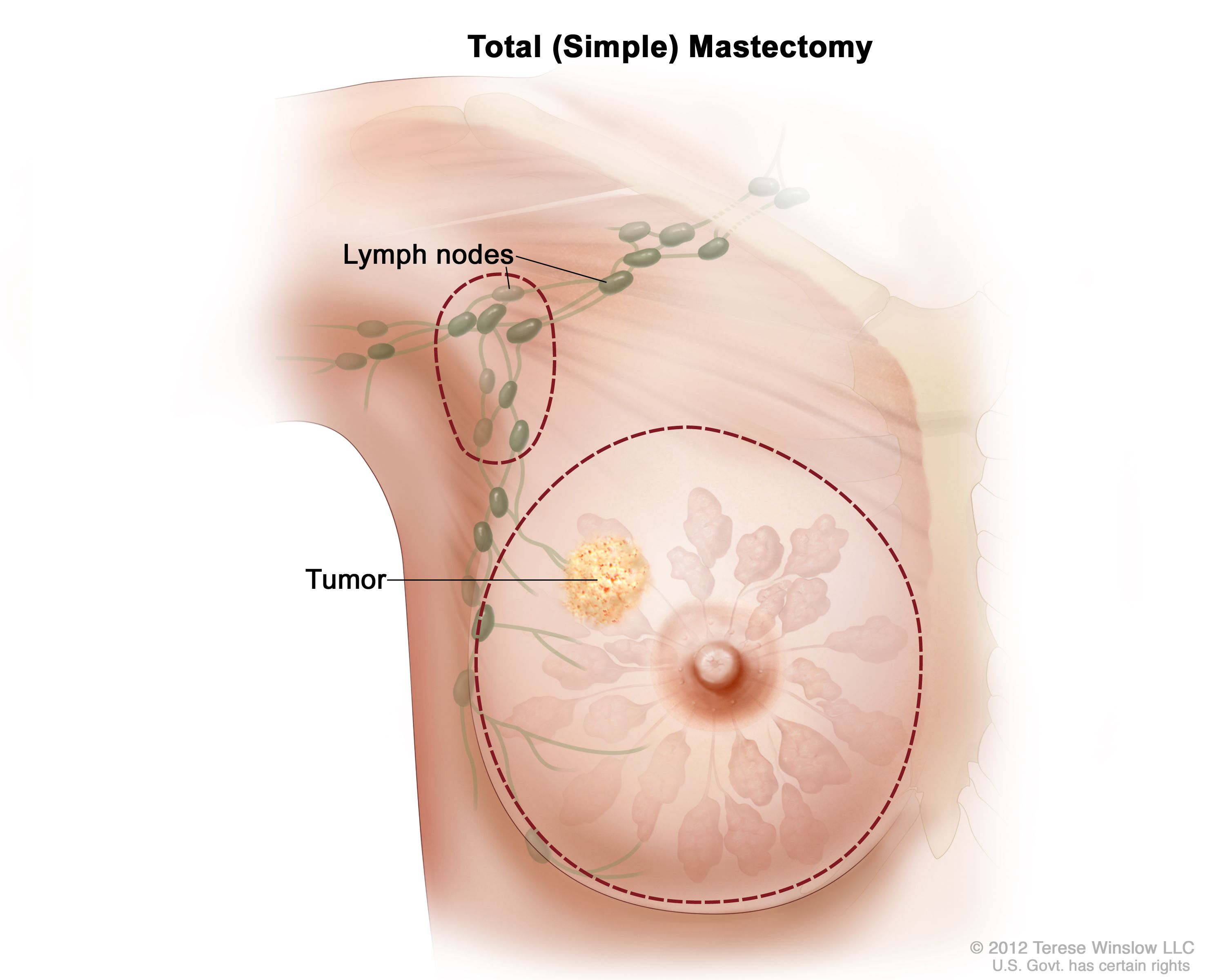 Mastectomy