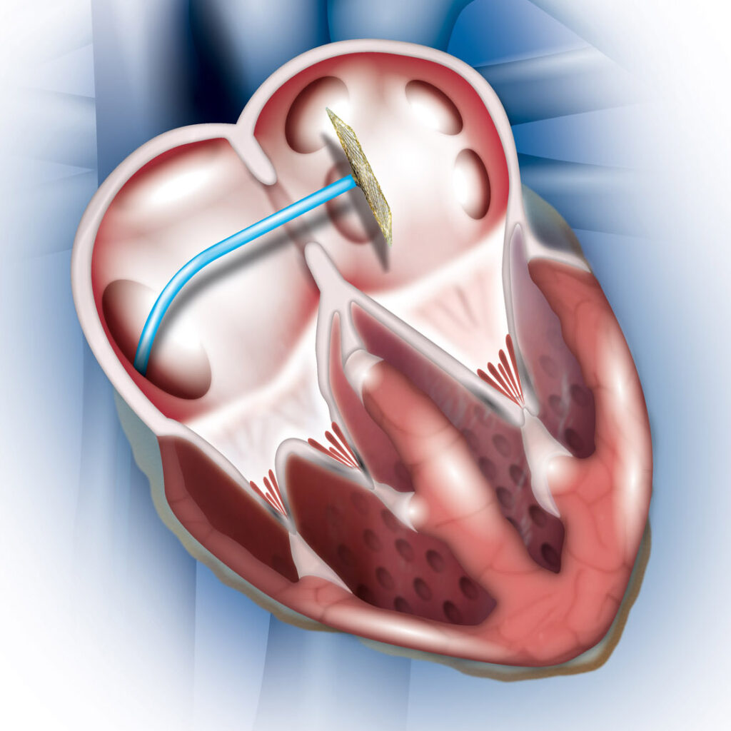 ASD Surgical Closure Open Surgery