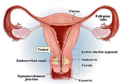 CX Stump Removal Abdominal