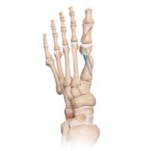 Valgus Osteotomy And ﬁxation