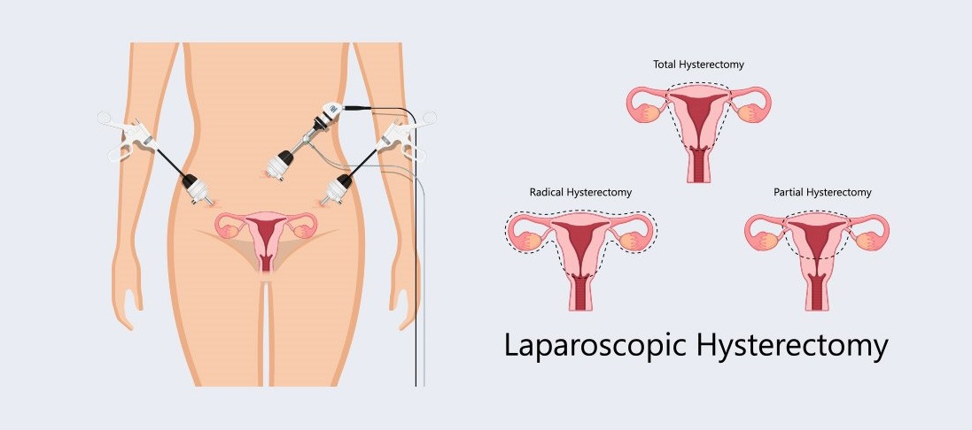 Diagnostic Laparo and Hystero and Eb