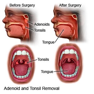 Adenoidectomy