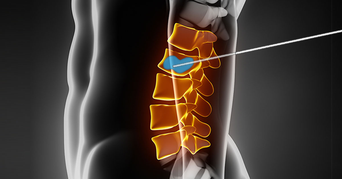 Kyphoplasty Balloon-Spine