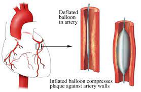 Coronary Angioplasty