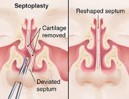 Septoplasty