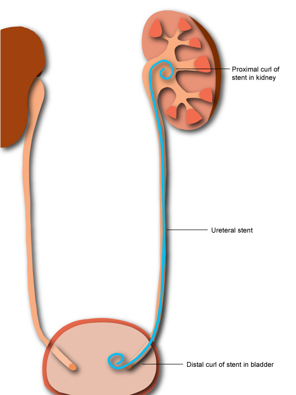 DJ Stent Removal Unilateral