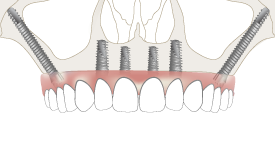 All On 4 With Zygoma Implants For Minimal Bone 4 Nobel Biocare Implants including 2 Zygoma Implants