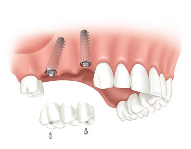 Individual Implants Adin Implant Israel System
