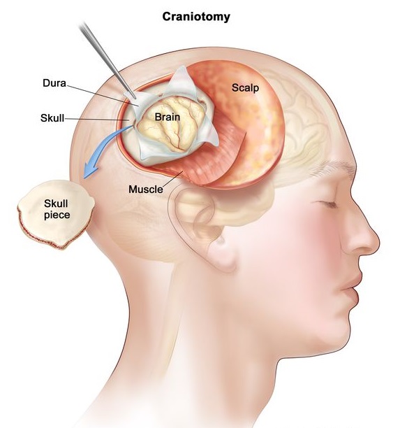 All Craniotomies For Elective Surgery Except Category A