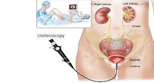 RIRS Bilateral Procedure