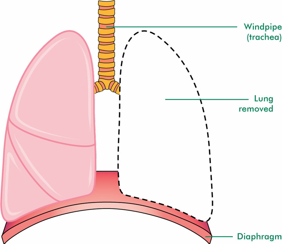 Pneumonectomy Oncosurgery