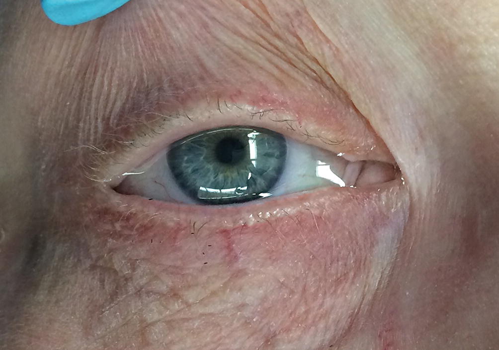 ORBIT AND OCULOPLASTY Canaliculoplasty Single Eye