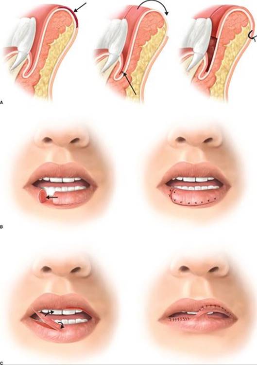 Lip Reconstuction and Multiple Flaps