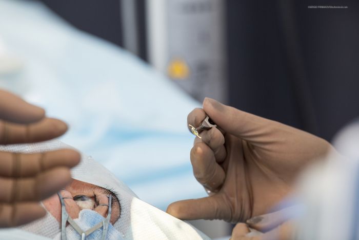 CATARACT Phaco with Indian Toric monofocal PCIOL Single Eye