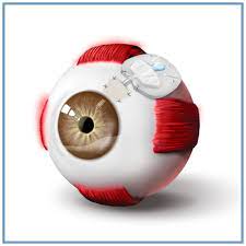 GLAUCOMA PROCEDURES Glaucoma Surgery with valve Single Eye